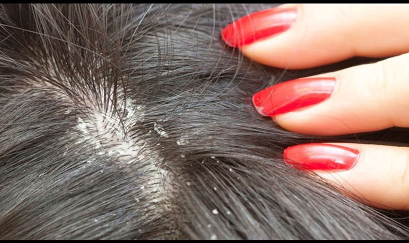dandruff