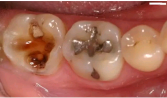 Tooth Worms