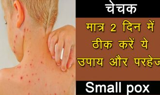 smallpox